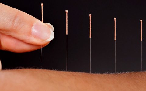 Acupuncture