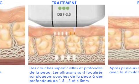Ultherapy mécanisme