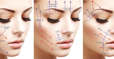 V-lifting visage