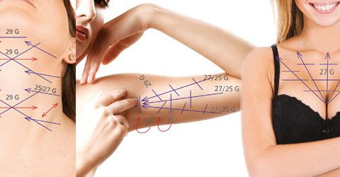V-Lifting coup bras décolleté
