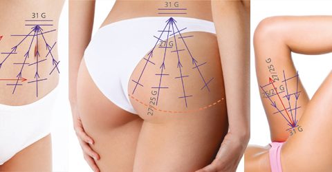 V-Lifting ventre fesse cuisse
