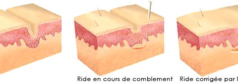 Comblement de ride