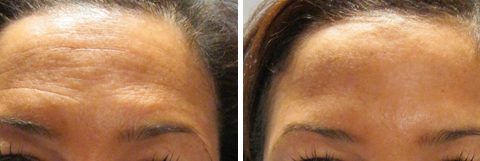 Botox Avant / Après