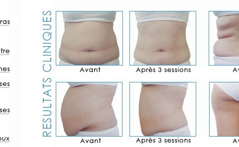 cryolipolyse avant-apres