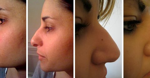 Correction du nez au radiesse