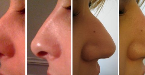 Correction du nez au radiesse