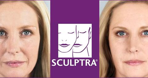 Scuptra avant/après